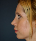 Feel Beautiful - Revision Rhinoplasty 204 - After Photo